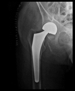 X-ray image of a hip joint showing a hip replacement implant in place. The artificial joint components are clearly visible against the surrounding bone structure.